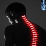 Omurga Kırığı ve Yaşlılarda Bel Ağrısı: Nedenleri, Belirtileri ve Tedavi Yöntemleri