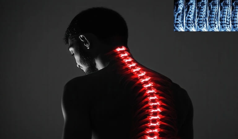 Omurga Kırığı ve Yaşlılarda Bel Ağrısı: Nedenleri, Belirtileri ve Tedavi Yöntemleri